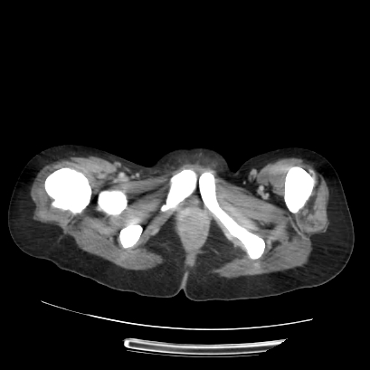 Acute calculous cholecystitis in patient with osteopetrosis (Radiopaedia 77871-90159 Axial C+ portal venous phase 82).jpg