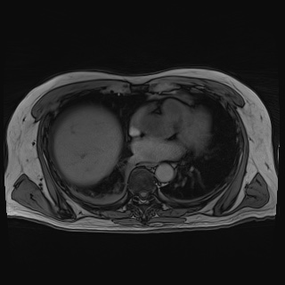 Acute cholecystitis (Radiopaedia 72392-82923 Axial T1 out-of-phase 11).jpg