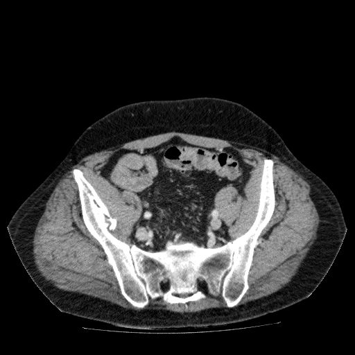 File:Acute cholecystitis and incidental left sided IVC (Radiopaedia 49352-54459 Axial C+ portal venous phase 122).jpg