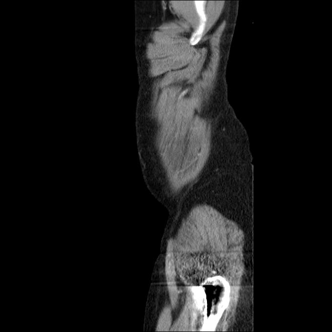 Acute cholecystitis and incidental left sided IVC (Radiopaedia 49352-54459 Sagittal C+ portal venous phase 85).jpg