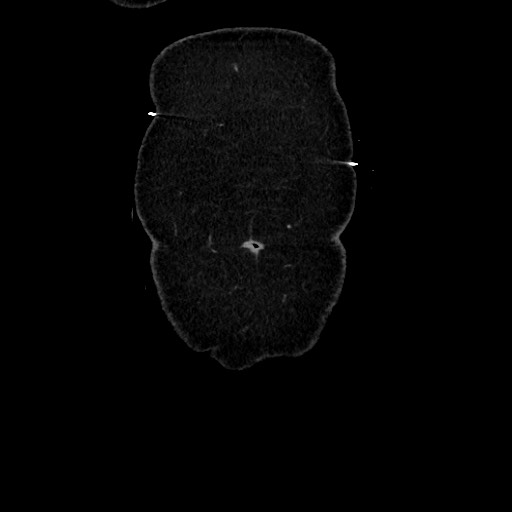 Acute diverticulitis - transverse colon (Radiopaedia 87063-103327 Coronal C+ portal venous phase 20).jpg