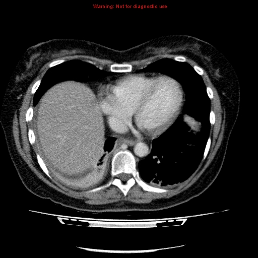 File:Acute gangrenous cholecystitis (Radiopaedia 10123-10661 Axial C+ portal venous phase 7).jpg