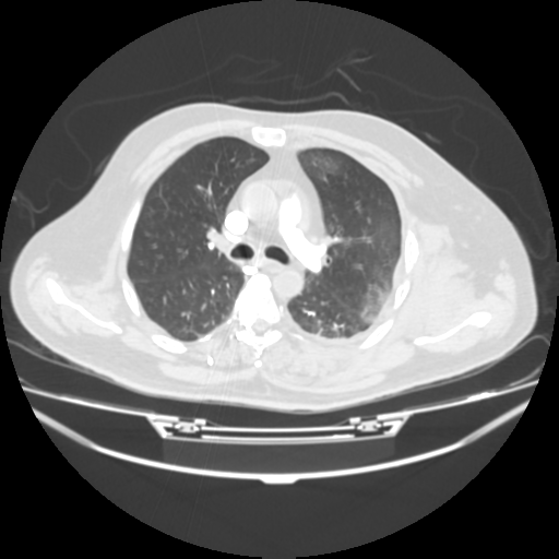 File:Acute heart failure (CT) (Radiopaedia 79835-93075 Axial lung window 18).png
