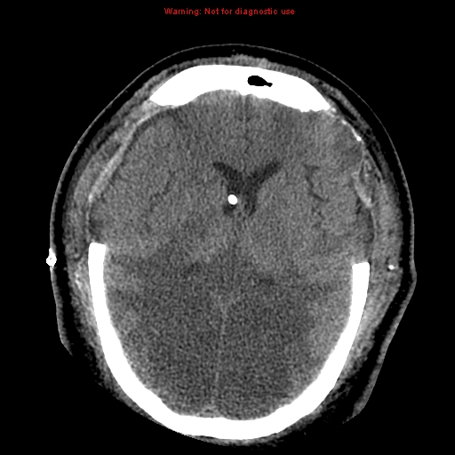 Acute hemorrhagic leukoencephalitis (Radiopaedia 14076-43697 Axial non-contrast 28).jpg