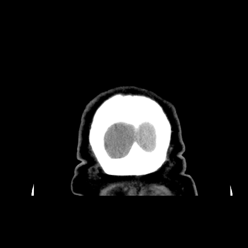 Acute hemorrhagic stroke (Radiopaedia 17507-17223 Coronal non-contrast 57).jpg