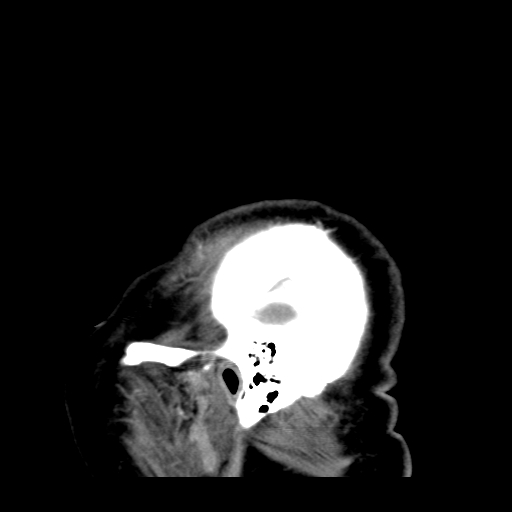 File:Acute hemorrhagic stroke (Radiopaedia 17507-17223 Sagittal non-contrast 2).jpg