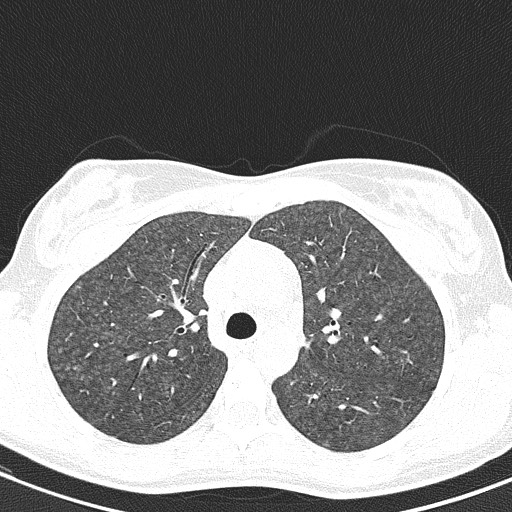 File:Acute hypersensitivity pneumonitis (Radiopaedia 85293-100870 Axial lung window 36).jpg