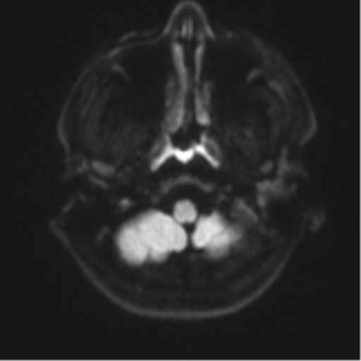 Acute left middle cerebral artery territory infarct with clot retrieval (Radiopaedia 47732-52433 Axial DWI 33).png
