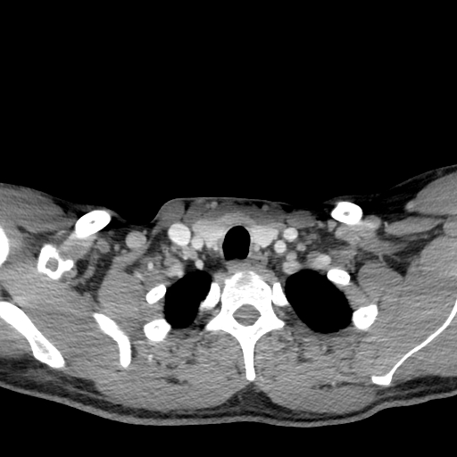 Acute longus colli calcific tendinitis (Radiopaedia 72495-83036 Axial C+ arterial phase 78).jpg