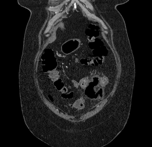 Acute mesenteric ischemia (Radiopaedia 80029-93316 Coronal C+ arterial phase 17).jpg