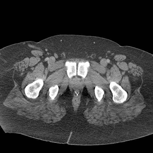 Acute mesenteric venous ischemia (Radiopaedia 46041-50383 Axial C+ portal venous phase 147).jpg