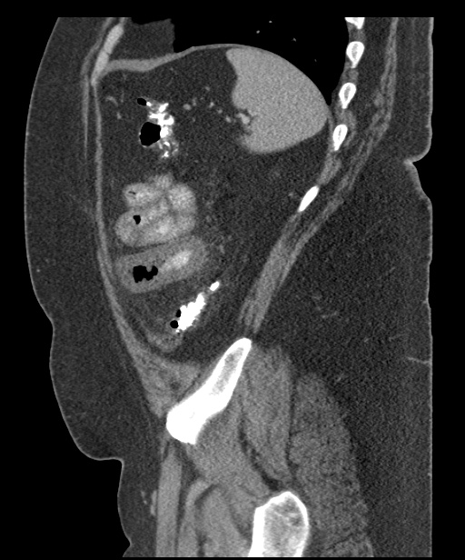 Acute mesenteric venous ischemia (Radiopaedia 46041-50383 Sagittal C+ portal venous phase 96).jpg