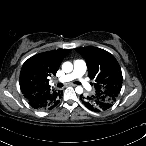 Acute myocardial infarction in CT (Radiopaedia 39947-42415 Axial C+ arterial phase 59).jpg