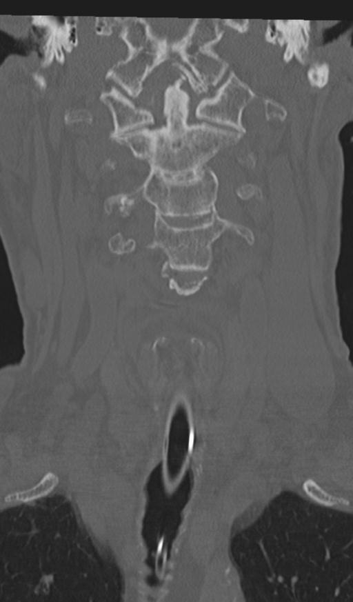Acute on chronic subdural hematoma and thoracic vertebral injury in a multitrauma patient (Radiopaedia 31698-32619 Coronal bone window 16).jpg