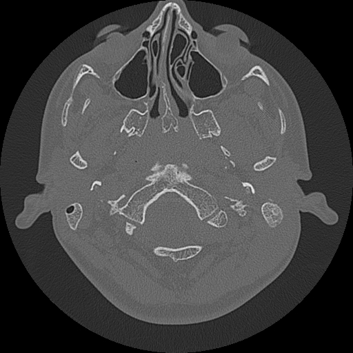 Acute otomastoiditis and Bezold abscess (Radiopaedia 88184-104786 Axial bone window 12).jpg