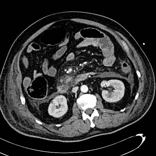 File:Acute pancreatic necrosis (Radiopaedia 13560-13486 Axial C+ portal venous phase 74).jpg