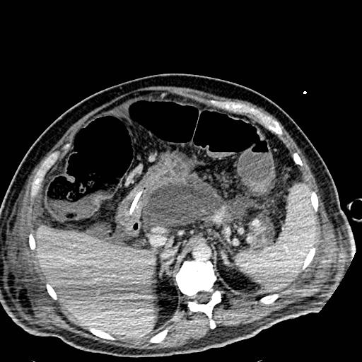 Acute pancreatic necrosis (Radiopaedia 13560-18501 Axial C+ portal venous phase 38).jpg