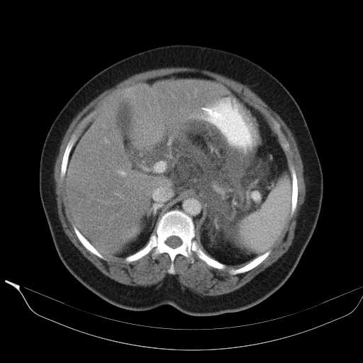 File:Acute pancreatitis (Radiopaedia 20829-20744 Axial C+ portal venous phase 14).jpg