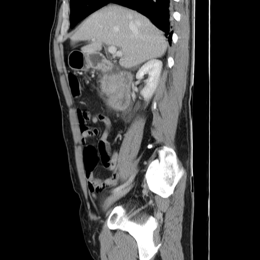 Acute pancreatitis (Radiopaedia 22572-22596 Sagittal C+ portal venous phase 19).jpg