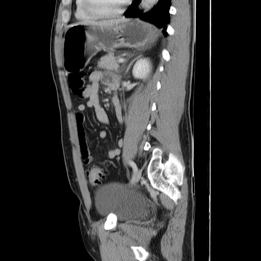 Acute pancreatitis (Radiopaedia 22572-22596 Sagittal C+ portal venous phase 35).jpg