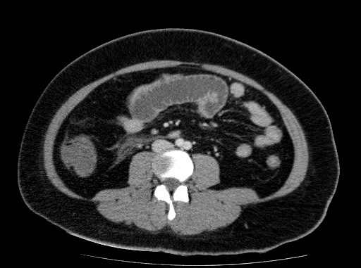 Acute pancreatitis (Radiopaedia 69236-79012 Axial C+ portal venous phase 54).jpg