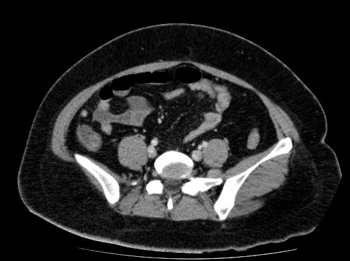 Acute pancreatitis (Radiopaedia 69236-79012 Axial C+ portal venous phase 65).jpg