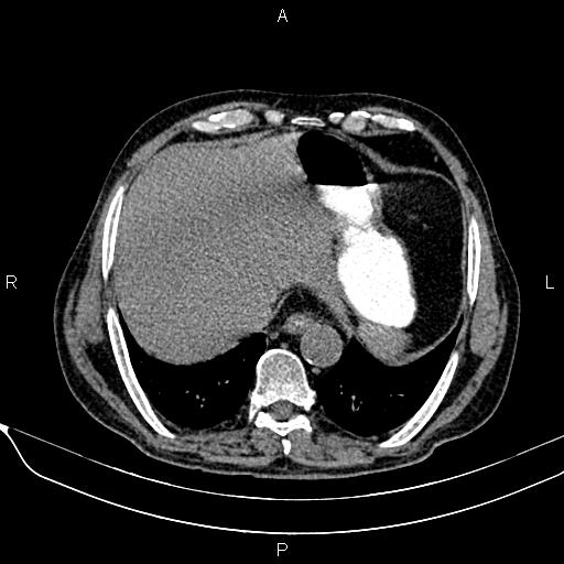 File:Acute pancreatitis (Radiopaedia 85146-100701 Axial non-contrast 21).jpg