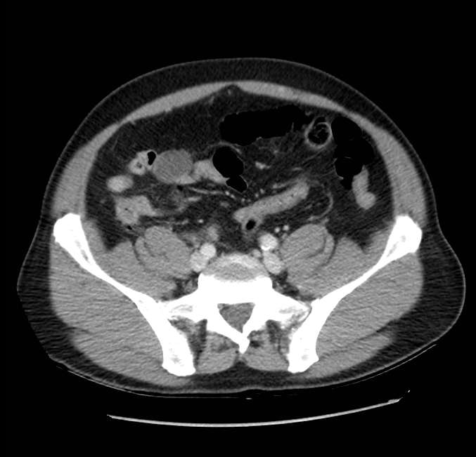 Acute pancreatitis - Balthazar E (Radiopaedia 23080-23110 Axial C+ portal venous phase 52).jpg