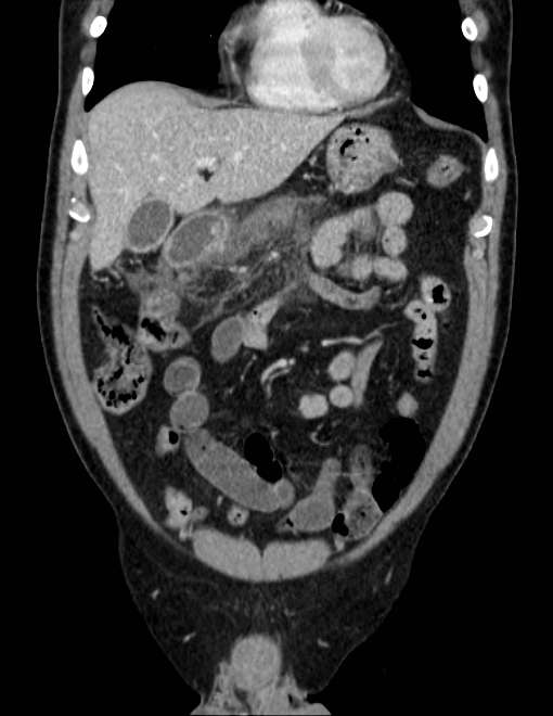 Acute pancreatitis - Balthazar E (Radiopaedia 23080-23110 Coronal C+ portal venous phase 21).jpg