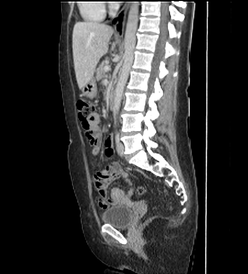 File:Acute pancreatitis - Balthazar E - post ERCP (Radiopaedia 27562-27772 Sagittal C+ portal venous phase 72).png
