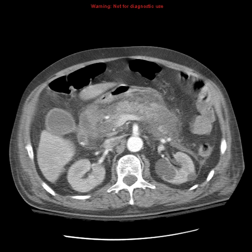 Acute pancreatitis with incidental pancreatic lipoma (Radiopaedia 10190-10730 Axial C+ arterial phase 39).jpg