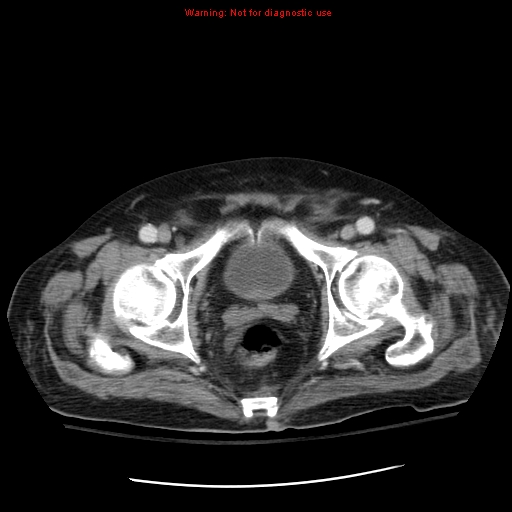 File:Acute pancreatitis with incidental pancreatic lipoma (Radiopaedia 10190-10730 Axial C+ portal venous phase 74).jpg