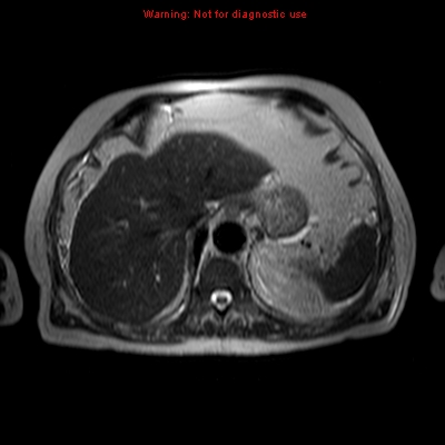 File:Acute pancreatitis with incidental pancreatic lipoma (Radiopaedia 10190-10732 Axial T2 21).jpg