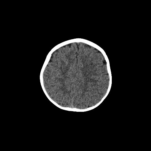 Acute phase of hemiconvulsion-hemiplegia epilepsy syndrome (Radiopaedia 29309-29744 Axial non-contrast 14).jpg