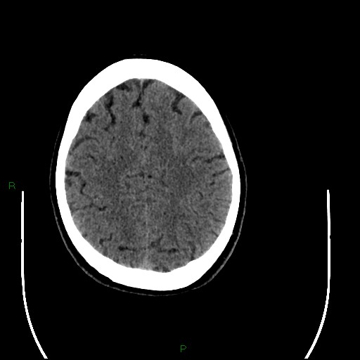 Acute posterior cerebral artery territory infarct (Radiopaedia 79329-92393 Axial non-contrast 83).jpg