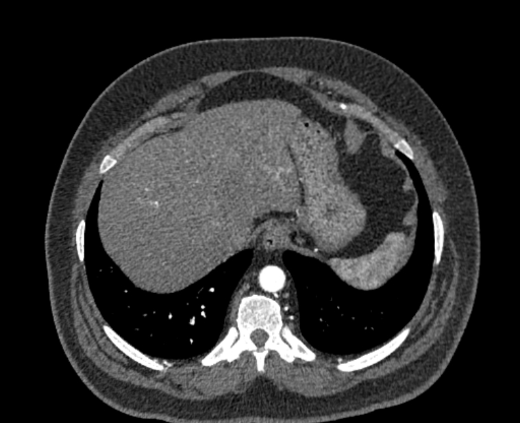 Acute pulmonary embolism with pulmonary infarcts (Radiopaedia 77688-89908 Axial C+ CTPA 58).jpg