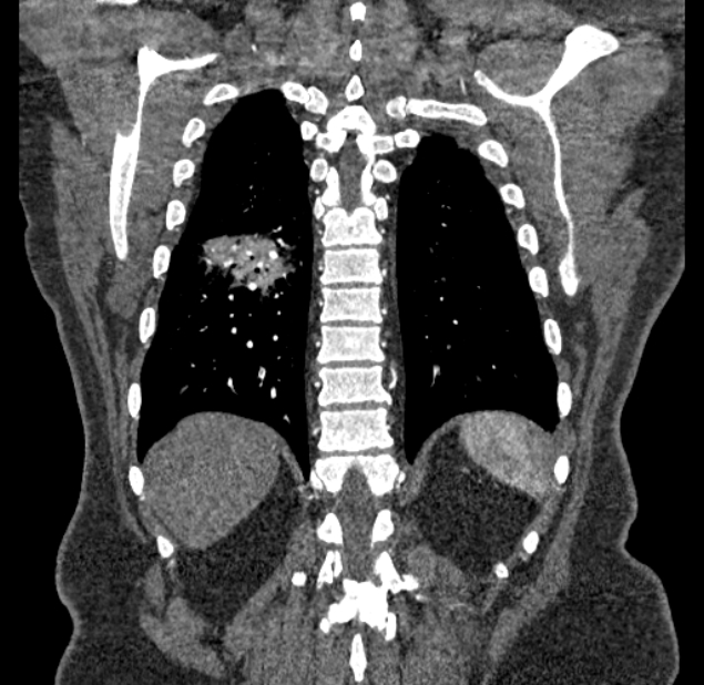 Acute pulmonary embolism with pulmonary infarcts (Radiopaedia 77688-89908 Coronal C+ CTPA 85).jpg