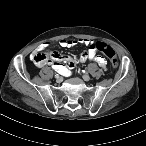 Acute renal infarction - rim capsular enhancement (Radiopaedia 59833-67270 Axial C+ portal venous phase 72).jpg
