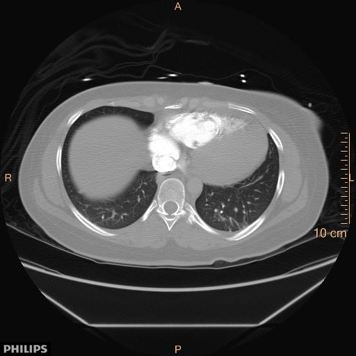 File:Acute reversible pulmonary hypertension and right heart failure from cocaine toxicity (Radiopaedia 49394-54517 Axial 4).jpg