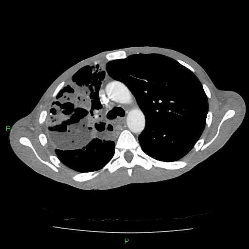 File:Acute right lung abscess (Radiopaedia 34806-36258 Axial C+ arterial phase 64).jpg