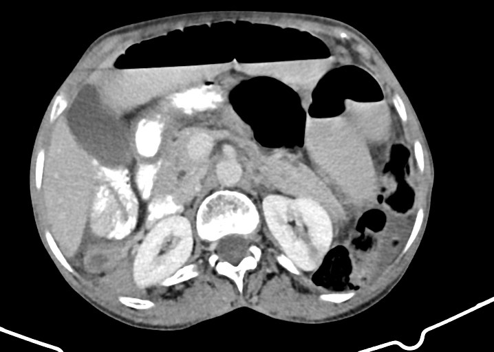Acute small bowel (ileal) volvulus (Radiopaedia 71740-82139 Axial C+ portal venous phase 78).jpg