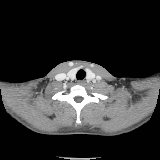 File:Acute submandibular sialadenitis secondary to ductal stone (Radiopaedia 27999-28267 Axial C+ delayed 39).jpg