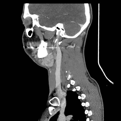 File:Acute submandibular sialadenitis secondary to ductal stone (Radiopaedia 27999-28267 Sagittal C+ delayed 9).jpg