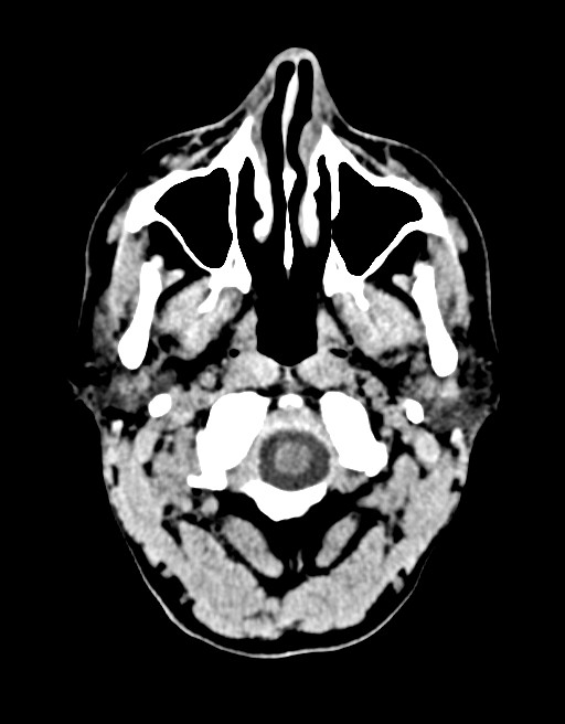 Acute superior cerebellar artery territory infarct (Radiopaedia 84104-99359 Axial non-contrast 65).jpg