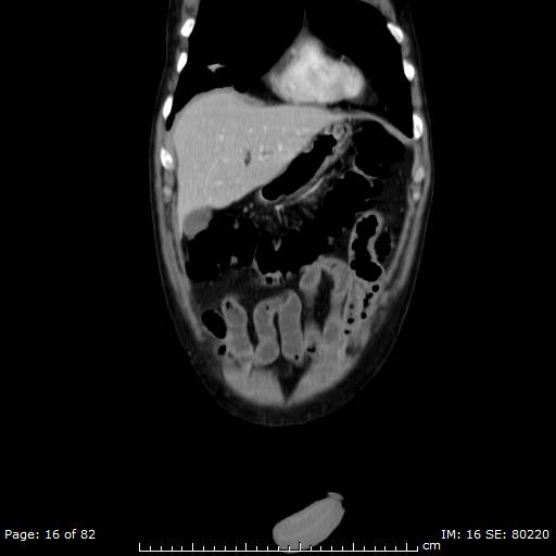 Acute superior mesenteric artery occlusion (Radiopaedia 43636-47060 Coronal C+ portal venous phase 1).jpg