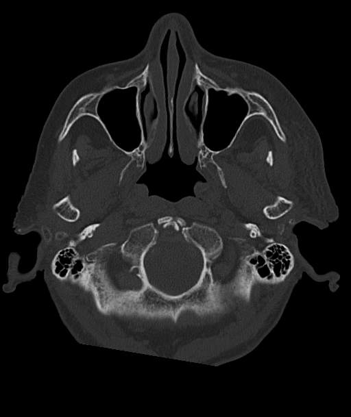 Acute traumatic subdural hematoma (Radiopaedia 82921-97257 Axial bone window 95).jpg