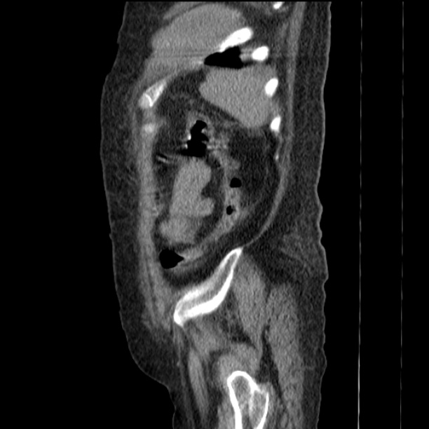 Acute tubular necrosis (Radiopaedia 28077-28334 Sagittal non-contrast 74).jpg