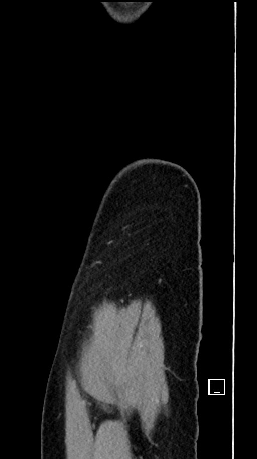 Acute uncomplicated appendicitis (Radiopaedia 61374-69304 Sagittal C+ portal venous phase 102).jpg