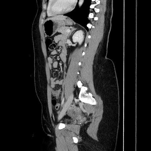 File:Acute uncomplicated appendicitis (Radiopaedia 73704-84499 Sagittal C+ portal venous phase 131).jpg