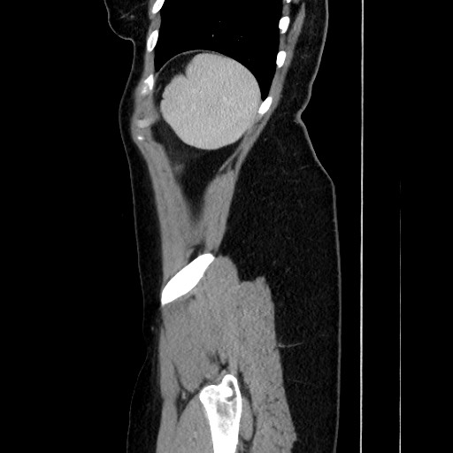 Acute uncomplicated appendicitis (Radiopaedia 73704-84499 Sagittal C+ portal venous phase 169).jpg